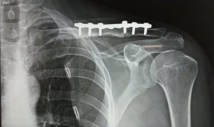 Postoperative clavicle x-ray showing callus formation