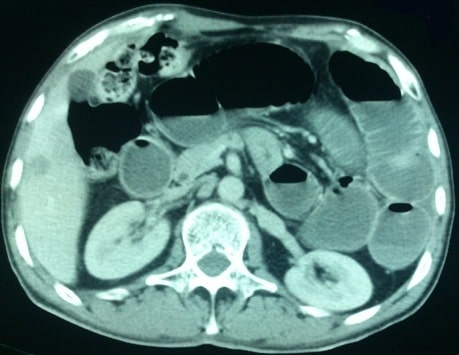 Post-operative transmesosigmoid hernia causing small bowel obstruction