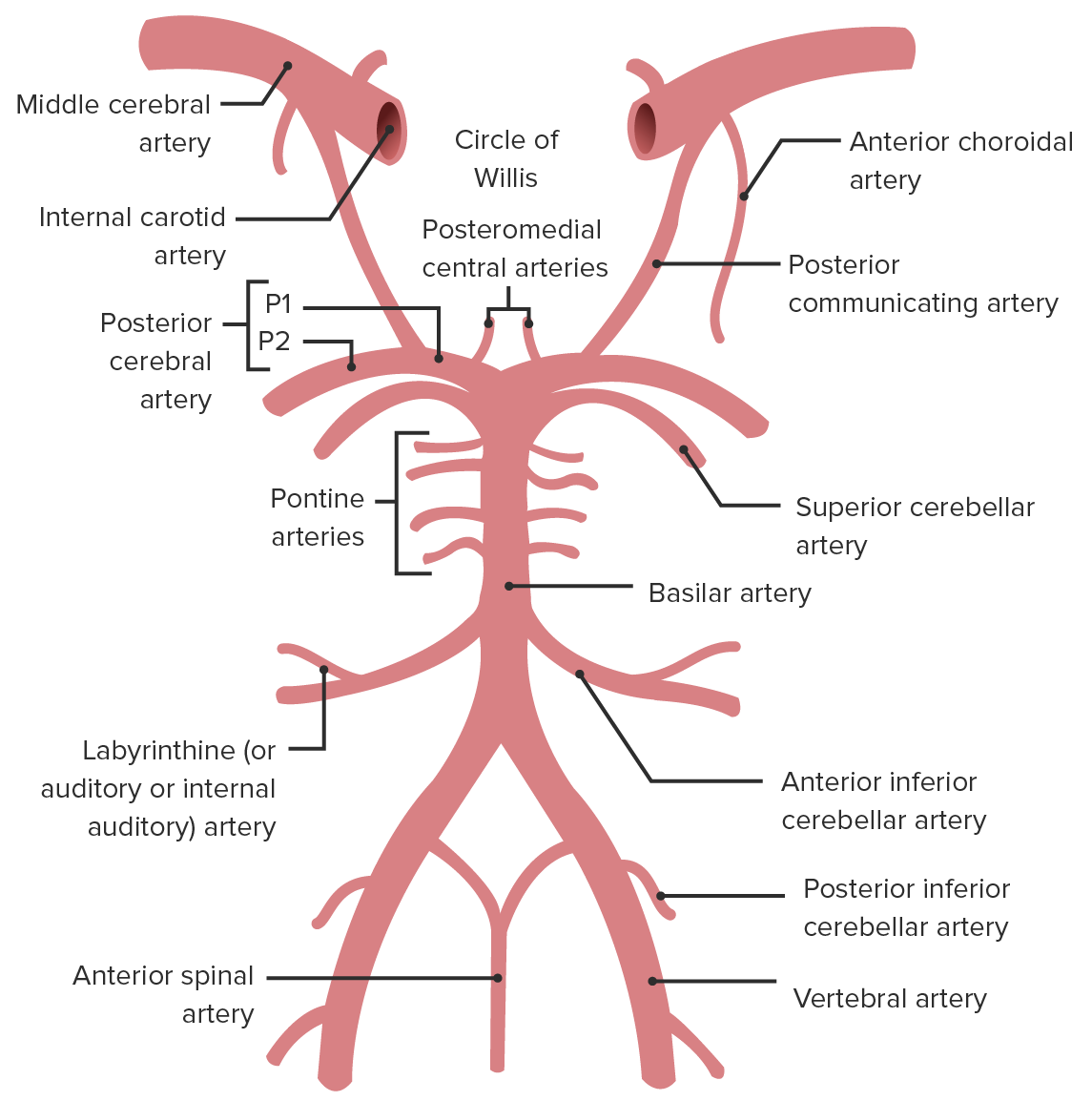 most likely source to cause pica artery infarction