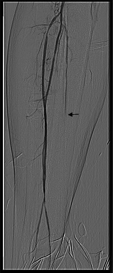Posterior tibial artery occlusion in middle segment