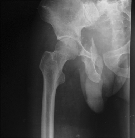 Posterior wall and column fracture of the right acetabulum and a fracture of the ipsilateral inferior ramus of pubis