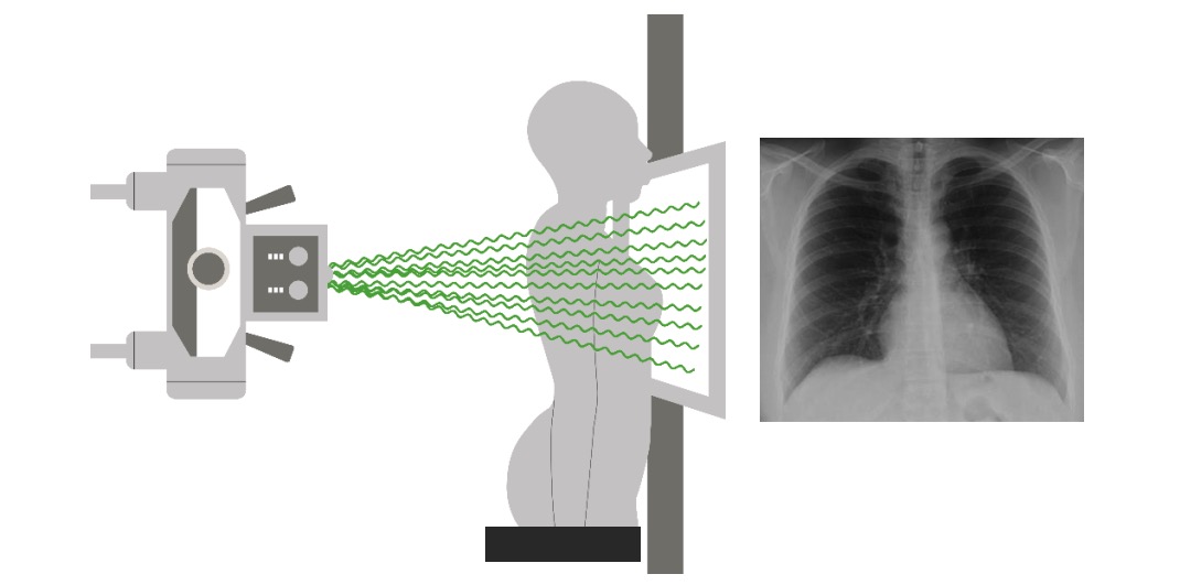 Posteroanterior (pa) x-ray projection