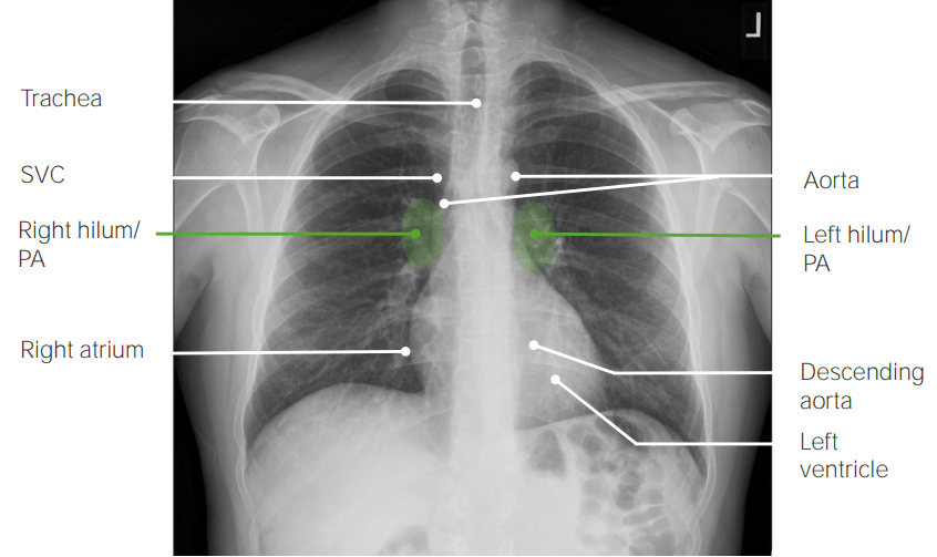 Vista posteroanterior (pa) en la radiografía de tórax que muestra hallazgos normales