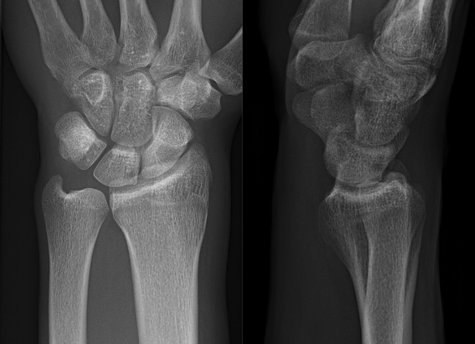 Posteroanterior (left) and lateral (right) projections of a normal left wrist