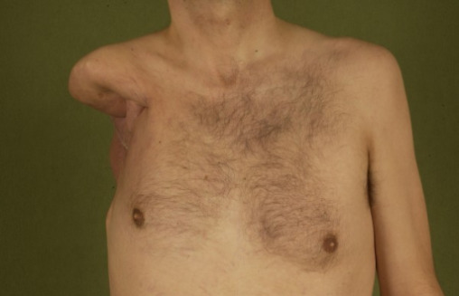 Postoperative aspect after extended shoulder disarticulation for synovial sarcoma