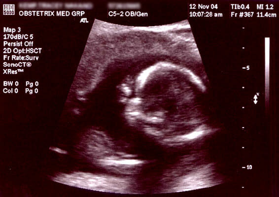 Prenatal ultrasonograph