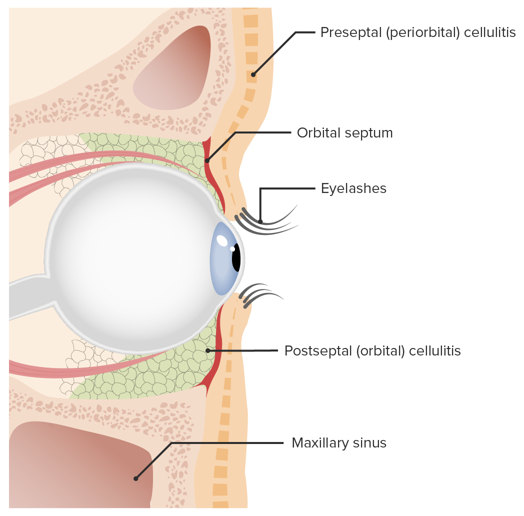 Celulites orbital e pré-septal - Distúrbios oftalmológicos - Manuais MSD  edição para profissionais