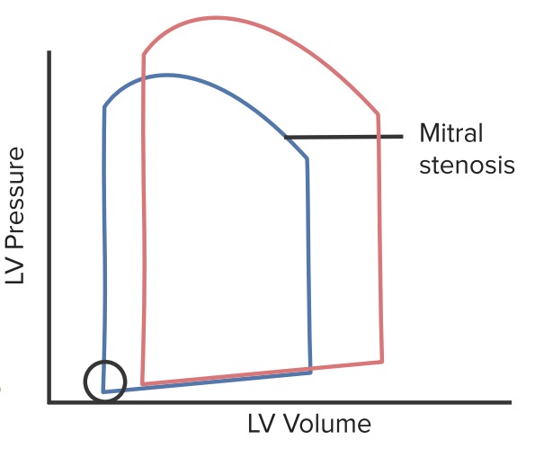 Pressure loop mitral stenosis
