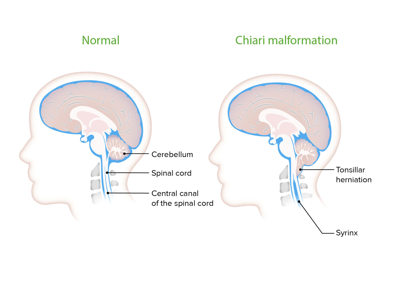 Chiari Malformations Concise Medical Knowledge