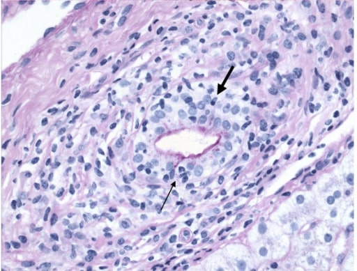 Primary Biliary Cirrhosis