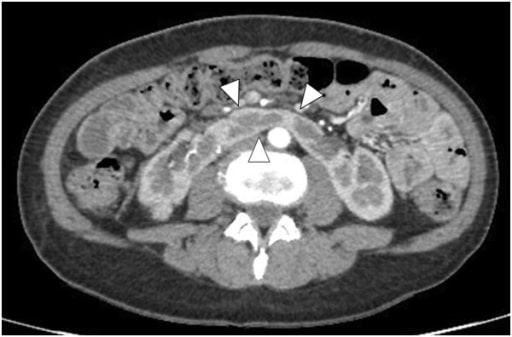 Primary leiomyosarcoma of a horseshoe kidney