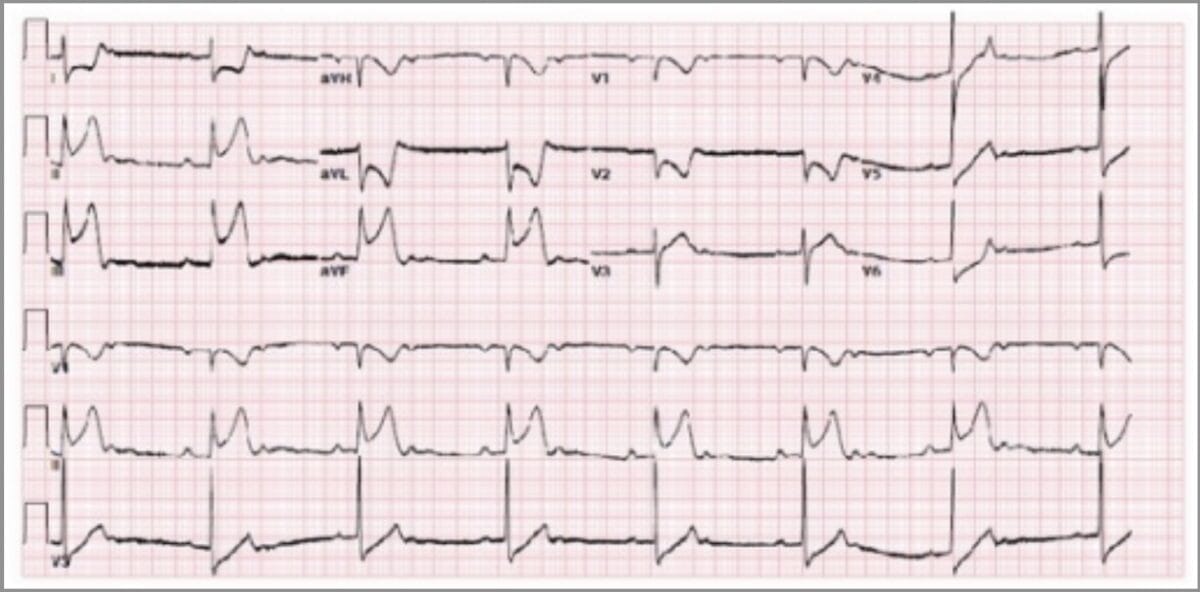 Prinzmetal angina