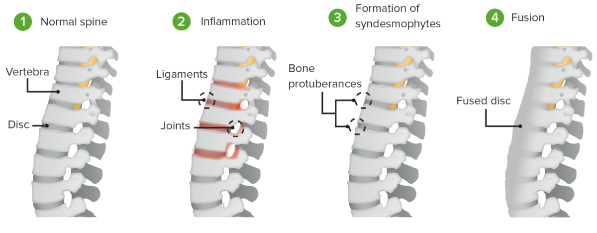 Process of ankylosis