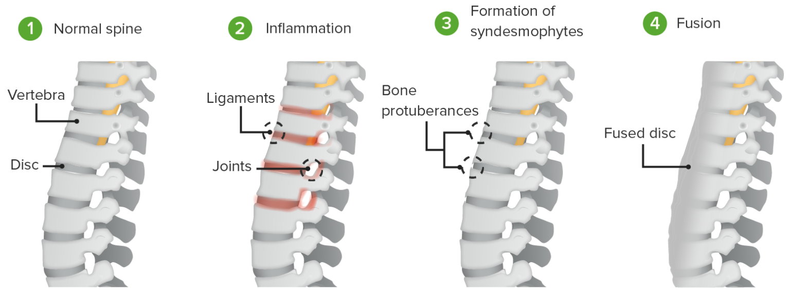 Ankylosing Spondylitis | Concise Medical Knowledge