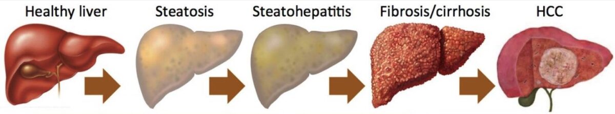 Progression of nafld