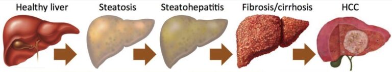 Nonalcoholic Fatty Liver Disease | Concise Medical Knowledge