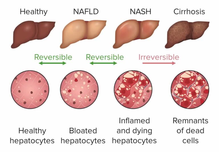 Nonalcoholic Fatty Liver Disease | Concise Medical Knowledge