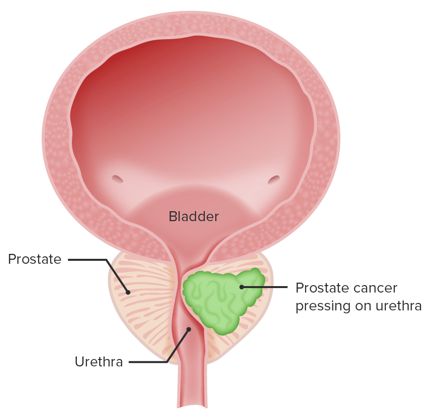 Prostate cancer pressing onto the urethra