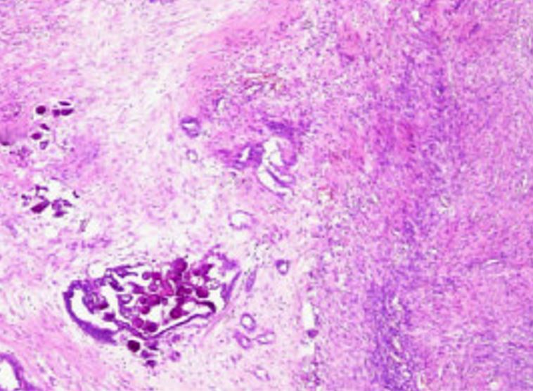 Corpos de psammoma em adenocarcinoma do ovário