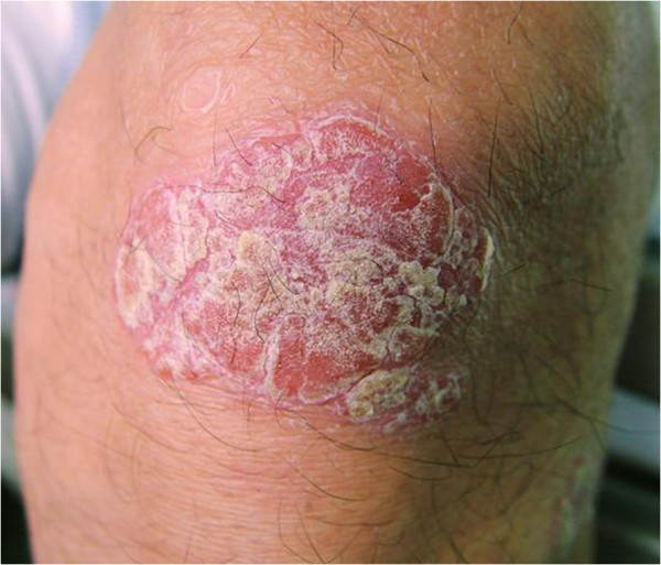 Psoriatic lesion on the knee