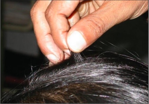 Pull-test for alopecia
