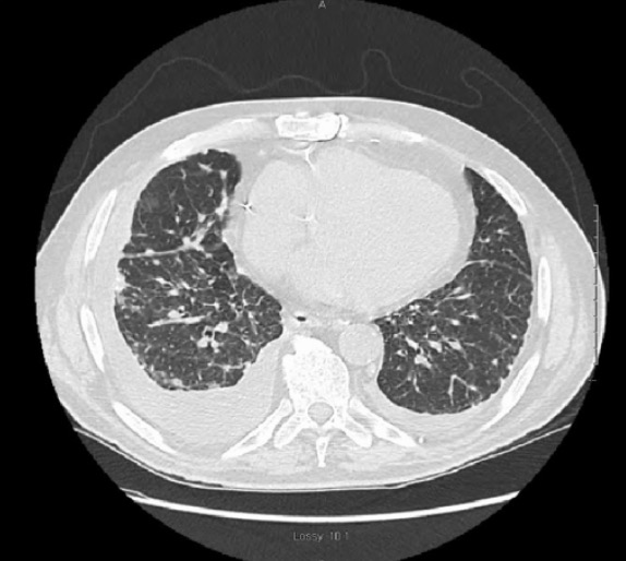 Pulmonary silicosis presents with pleural effusion