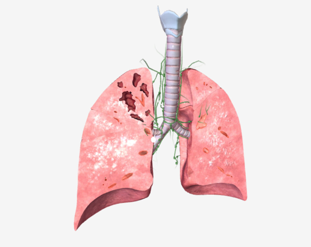 Pulmonary tuberculosis