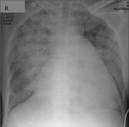 cephalization of pulmonary vessels