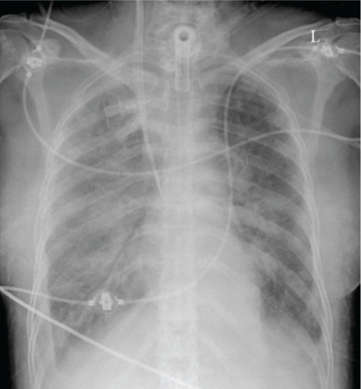 Pulmonary edema on x-ray