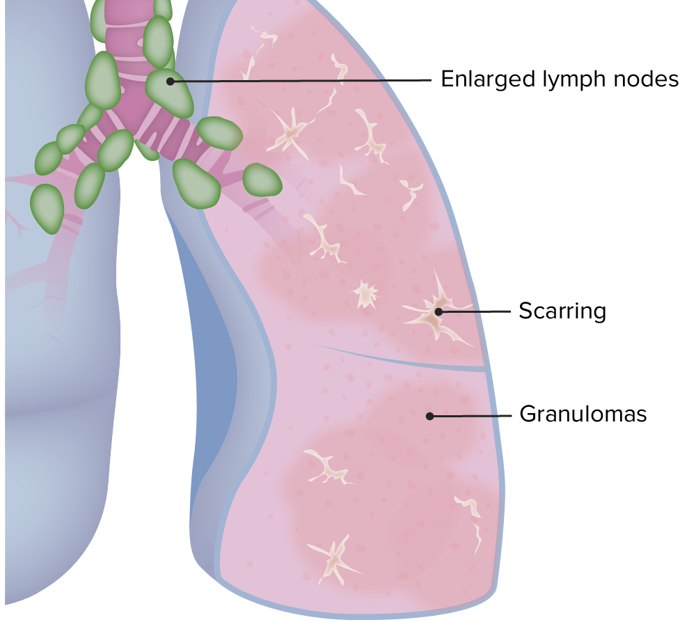 Pulmonary manifestations of sarcoidosis