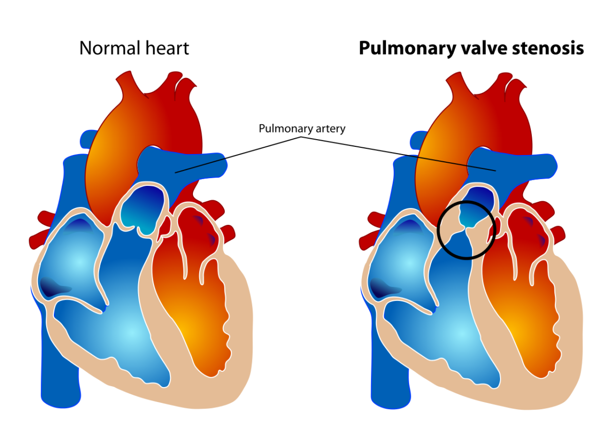 Estenosis de la válvula pulmonar