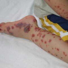 Purpura evident on the distal extremities of a pediatric patient