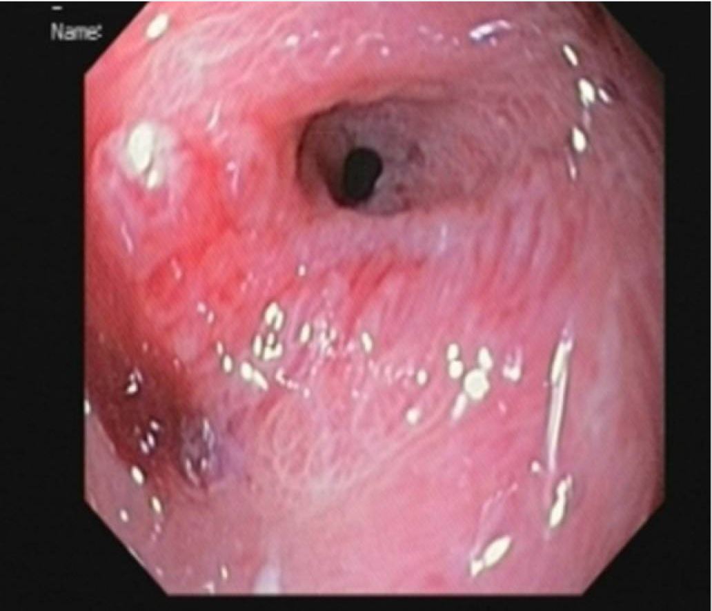 Pyloric stenosis esophagitis