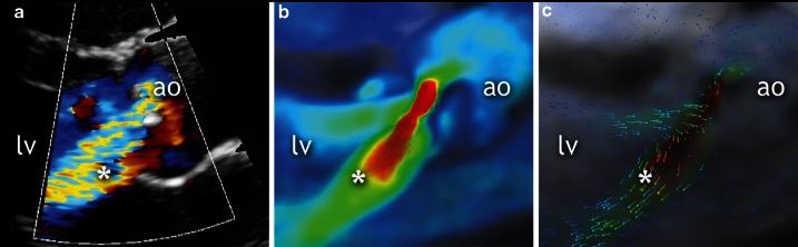 Qualitative grading of aortic regurgitation