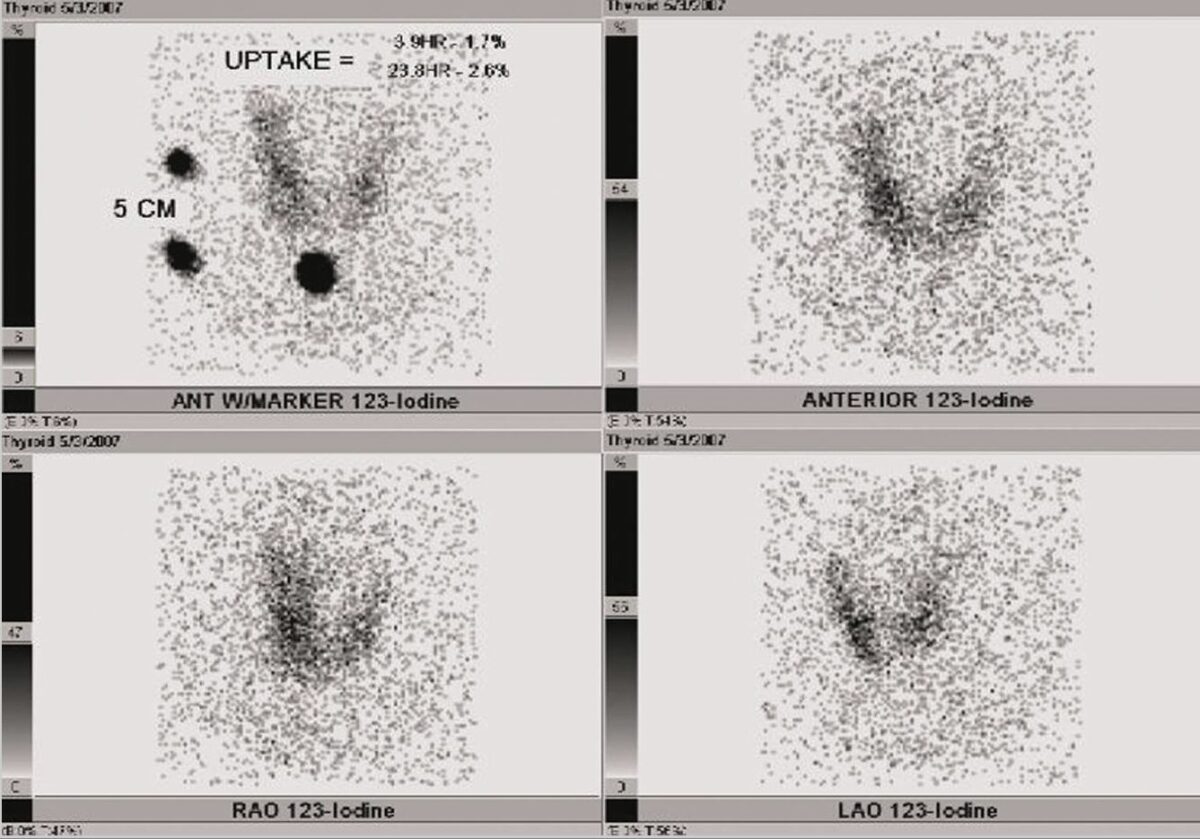 Radioactive iodine uptake (raiu) of the thyroid