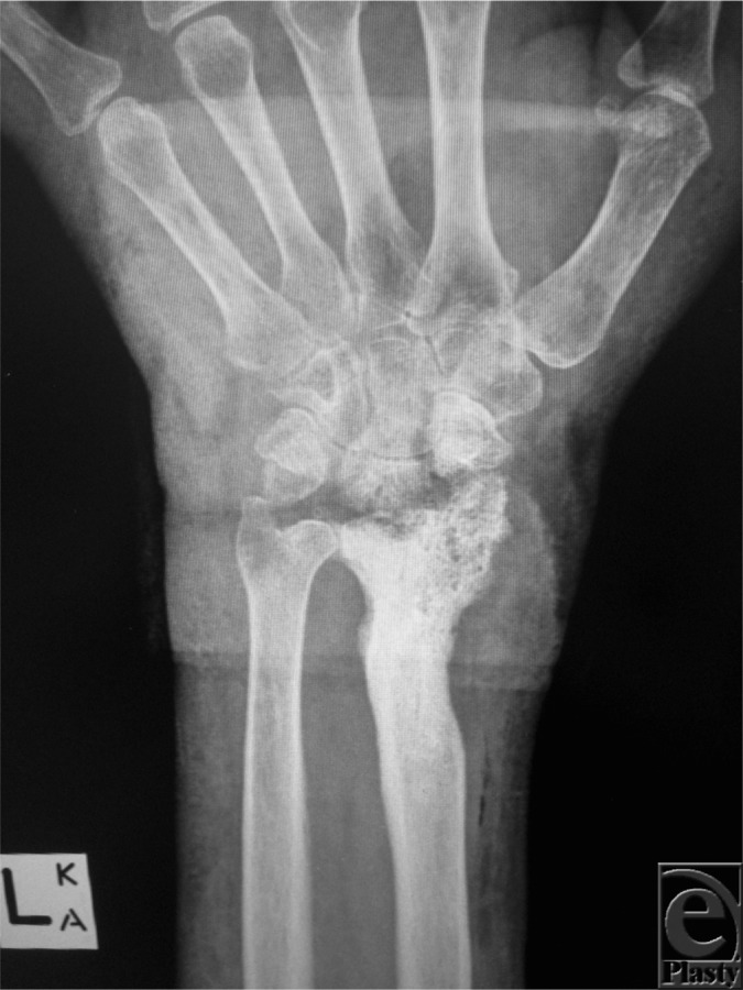 Radiograph chronic osteomyelitis