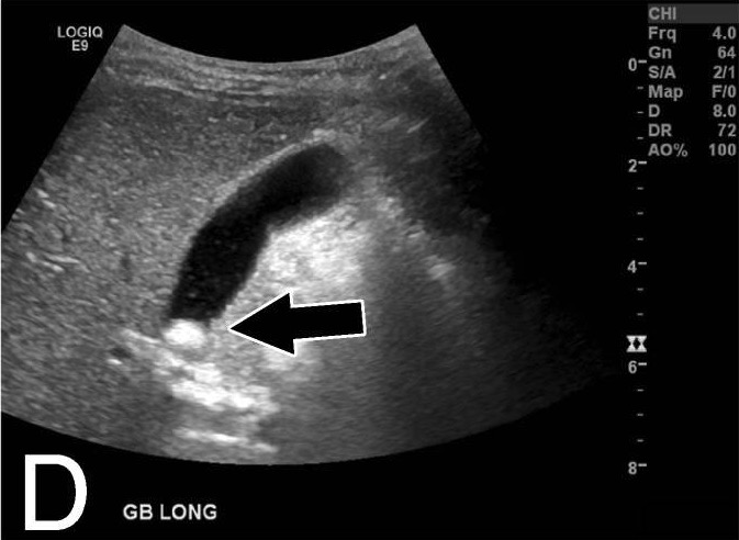 Radiograph of a gallstone