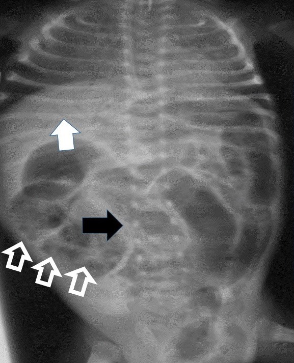 Radiograph of a patient with necrotizing enterocolitis
