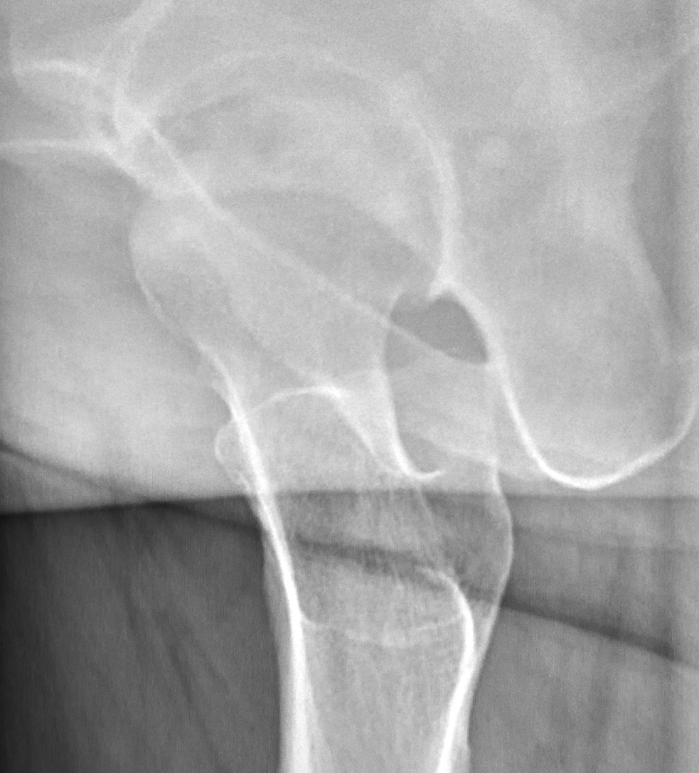 Radiograph of avascular necrosis can show osteopenia