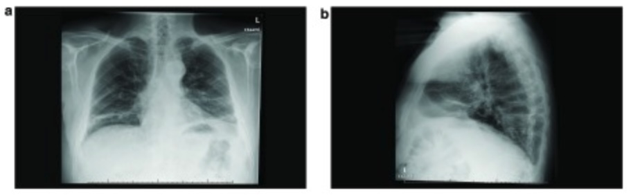 Radiograph of bilateral diaphragmatic paralysis
