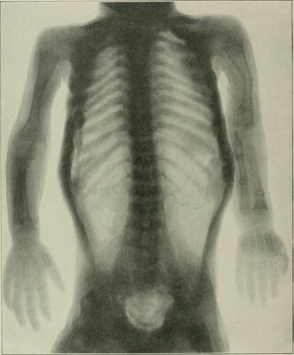 Radiograph showing osteogenesis imperfecta