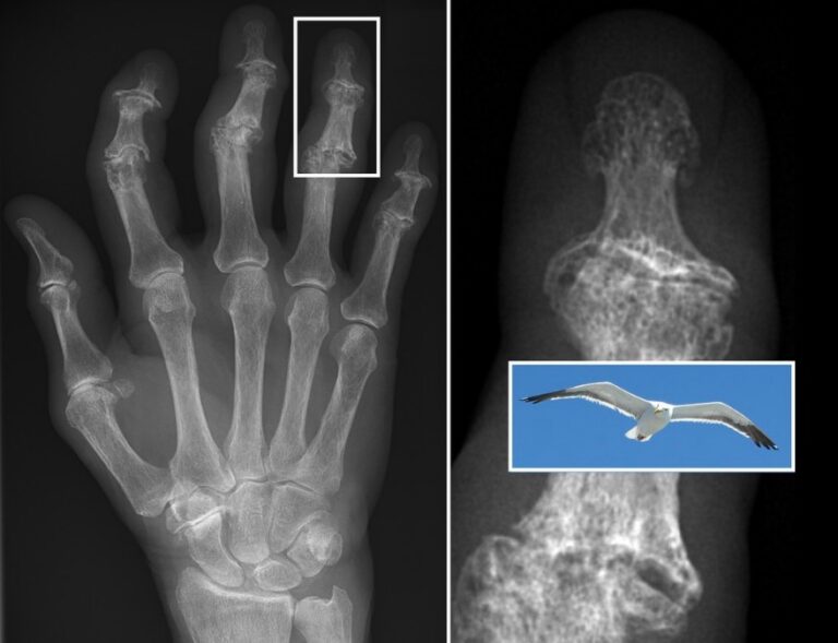 Osteoartrite | Concise Medical Knowledge