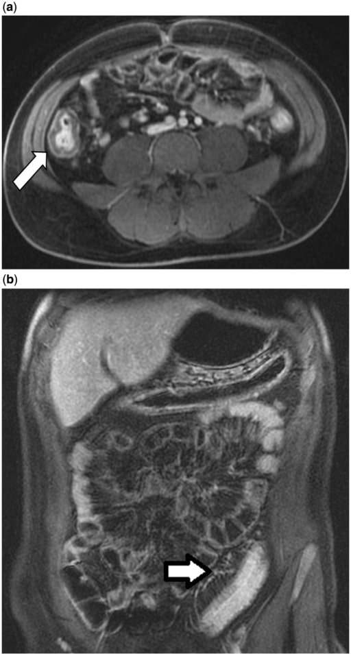 Radiographical evaluation of ulcerative colitis