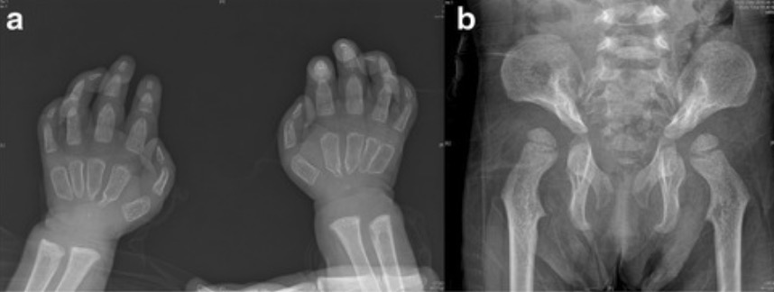 Radiographs of 21-month-old korean girl with ml ii
