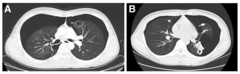 Radiographs of bilateral pneumothorax