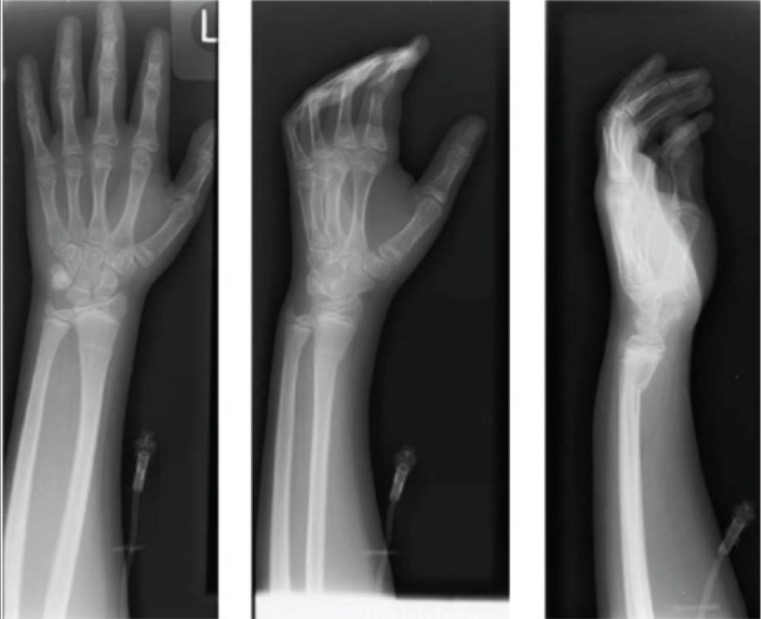 Radiographs of left wrist showing apex-dorsal distal radius buckle fracture