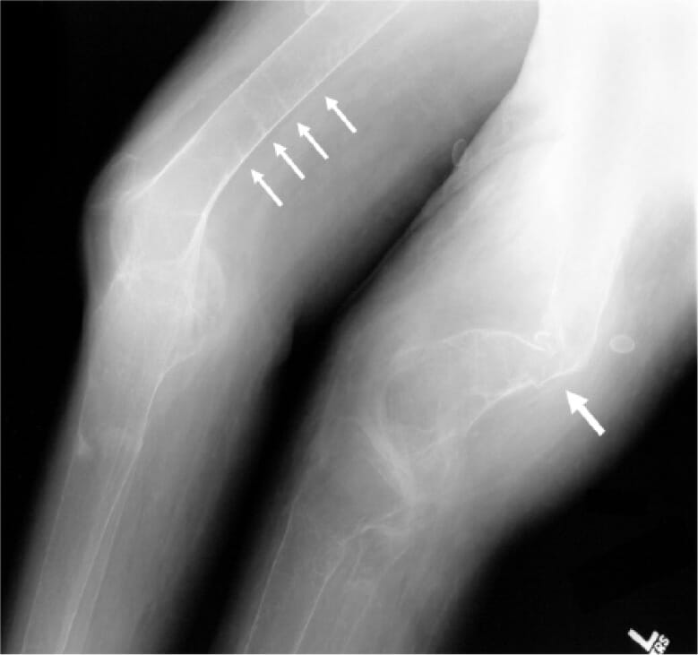 Radiographs of the right distal femur