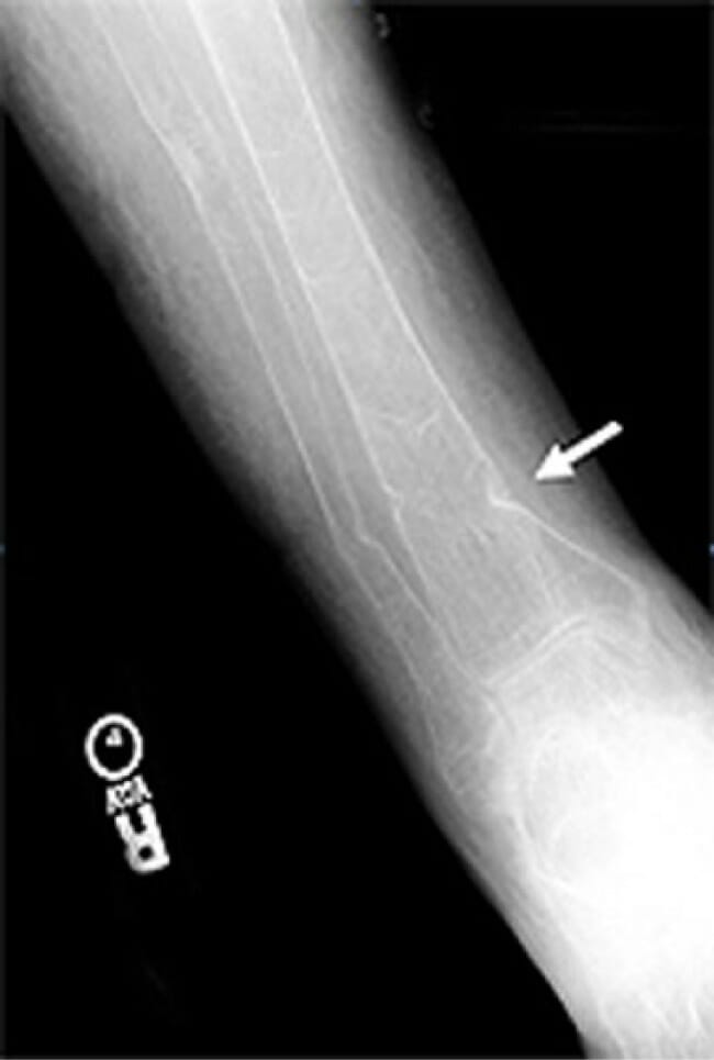 Radiographs of the right distal femur1