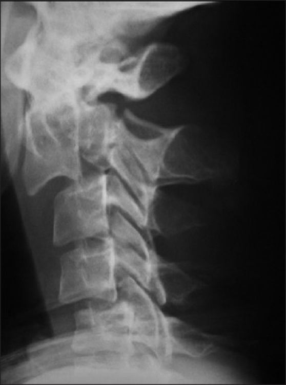 Radiography shows dens fracture on c2