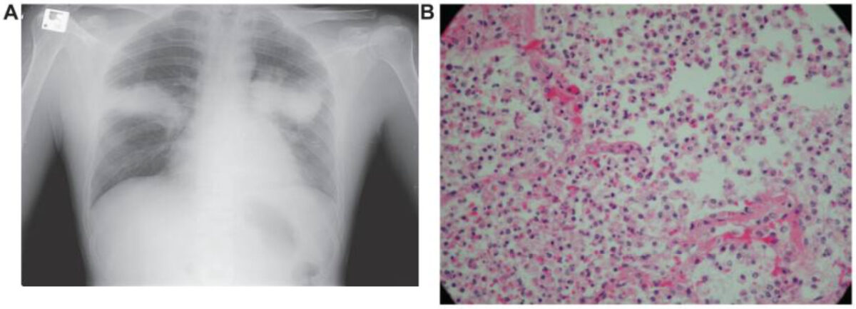 Radiological (a) and pathological (b) representation of klebsiella pneumonia